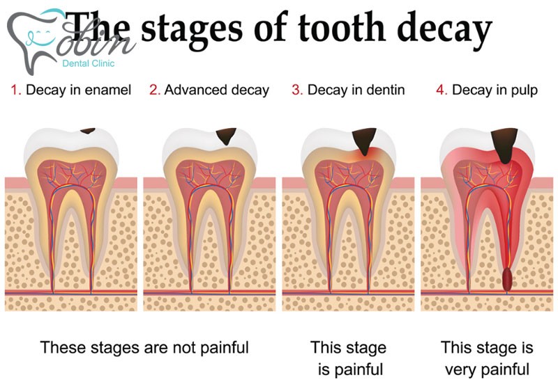 تصویری از مراحل مختلف پوسیدگی دندان ها